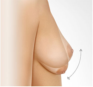 breast lift tunisia